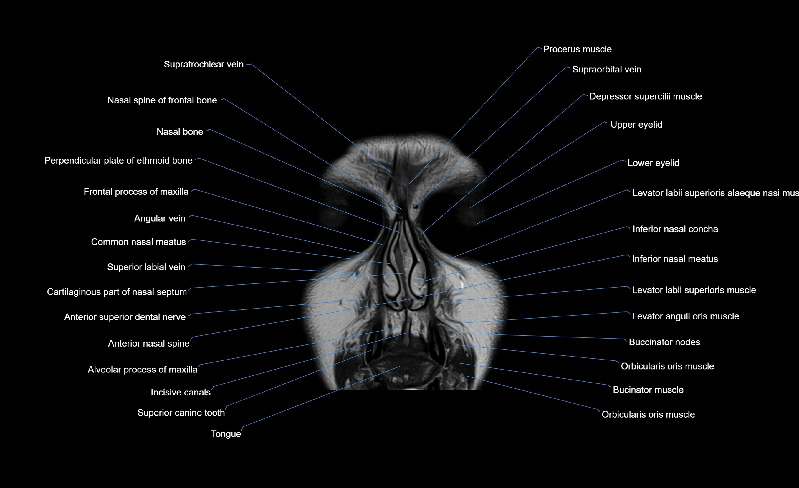MRI face & paranasal sinuses(PNS) labelled  coronal  cross sectional anatomy 3T radiology  image-img-00001-00012.webp